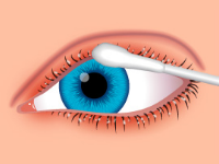 Blepharitis