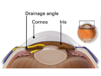 Glaucoma